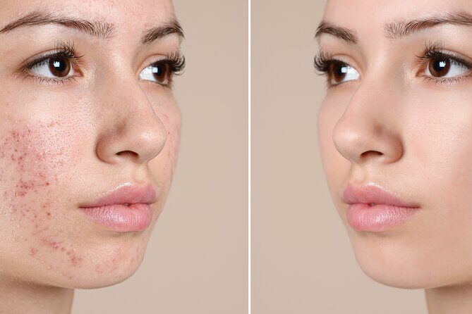 Skin Glo Package w/microderm/LED- For 2 with Appetizers and Wine - Frequently Asked Questions